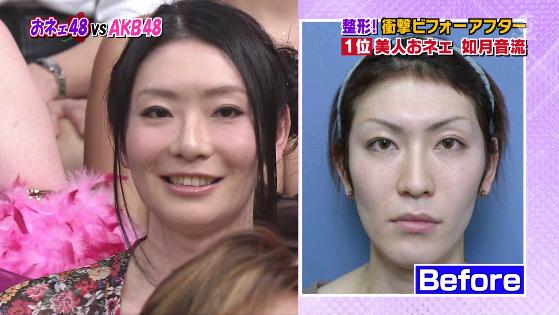 頭蓋顔面骨形成術 骨格を変える高額整形法 女性らしい顔つきに